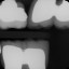 009 teeth num 14-17 X22012_2.jpg