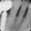017 teeth num 10-12 X22012_1.jpg